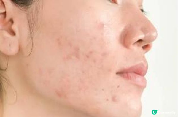 75分鐘時間速效急救爛面 一次過解決暗粒、毛孔、甩皮皮膚問題