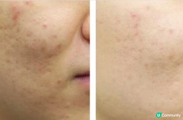 75分鐘時間速效急救爛面 一次過解決暗粒、毛孔、甩皮皮膚問題