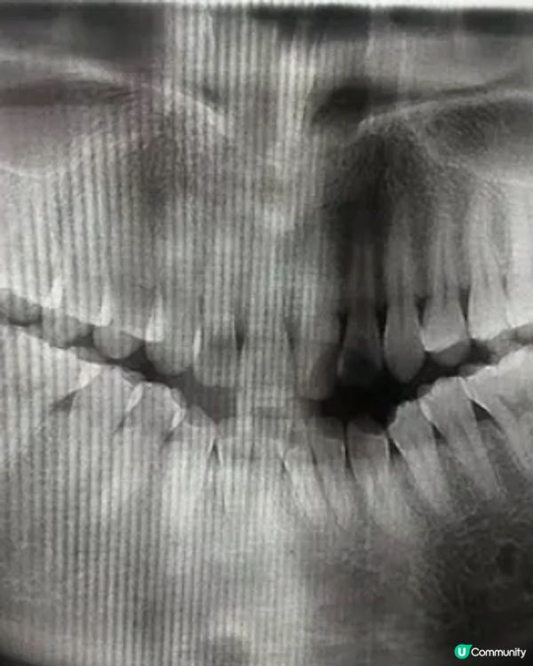 上深圳搞掂兩粒智慧牙