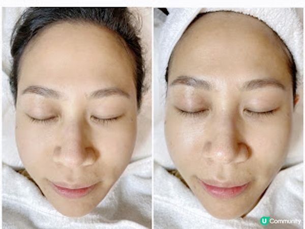 ★韓國大熱童顏施術 @ TONYBLACK韓式美容護理中心★