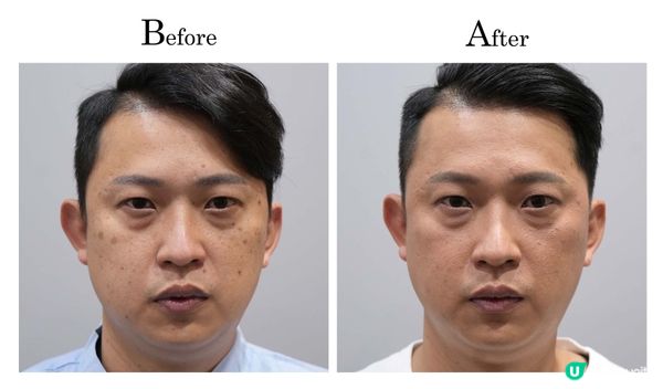 男生也飽受色斑困擾！熟男親測皮秒療程：Cosmax VS Perfect Men，實測這款更得男人心！