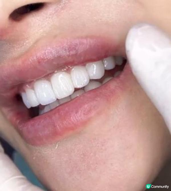 Hong Kong all-ceramic teeth recommendation, my experience of replacing dental crowns in Shenzhen Vic