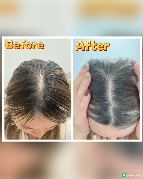 控頭油及防脫髮超有效