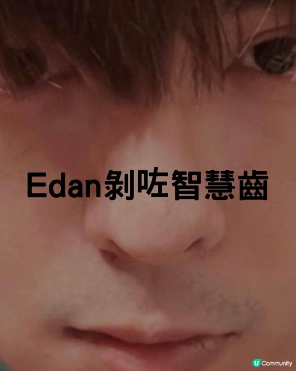 Edan剝完智慧齒都影比我哋睇