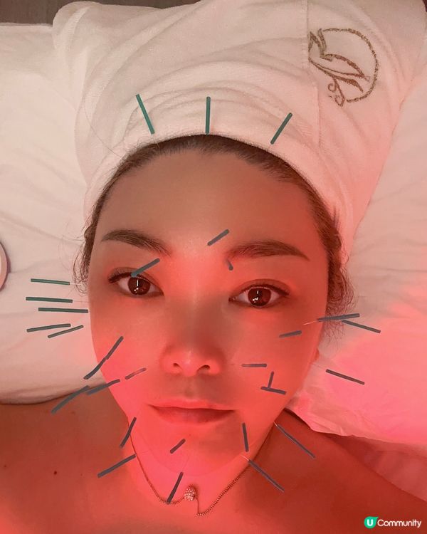 中醫美顏針初體驗，一次即見效果超神⚡️入黎攞優惠一齊靚