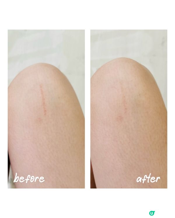 ❤️ Mepiform有效除疤