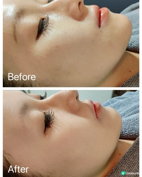 You Sky Beauty Salon皮秒去斑療程