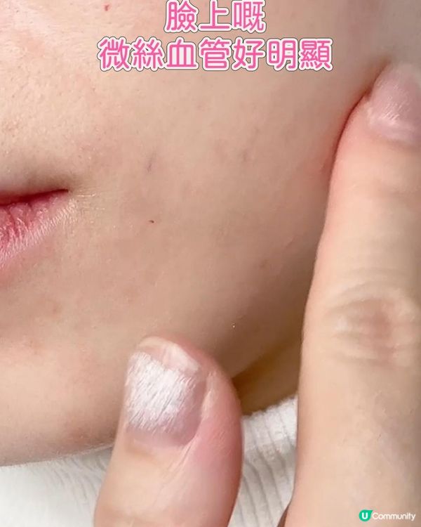 打走微絲血管💯一次搞點🩷
