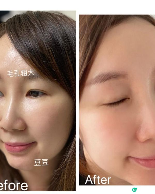 #全球最頂尖的LED面膜儀