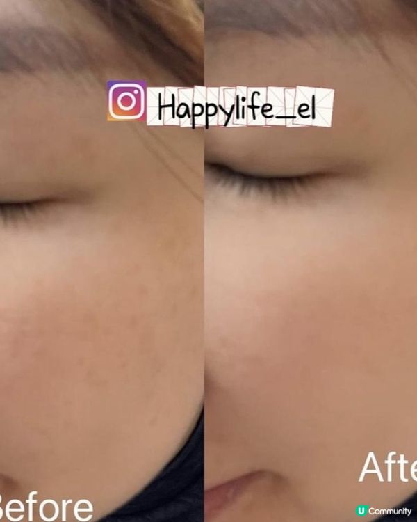 #全球最頂尖的LED面膜儀