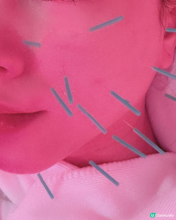 一次見效💕中醫瘦面美顏針➕暖宮療程