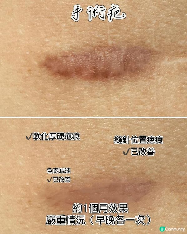 美德瑪® Mederna® 深層除疤啫喱