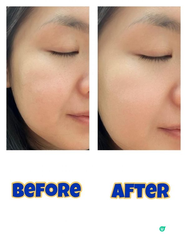 快速去斑💙enLIGHTen™ Pico 皮秒激光去斑療程💙 