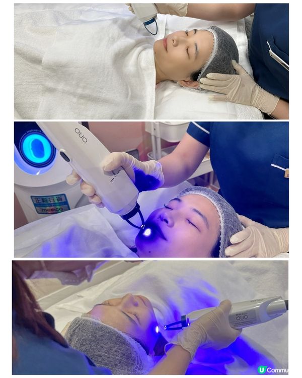 【護膚心得】CAPRI藍激光療程 痘痘清晒