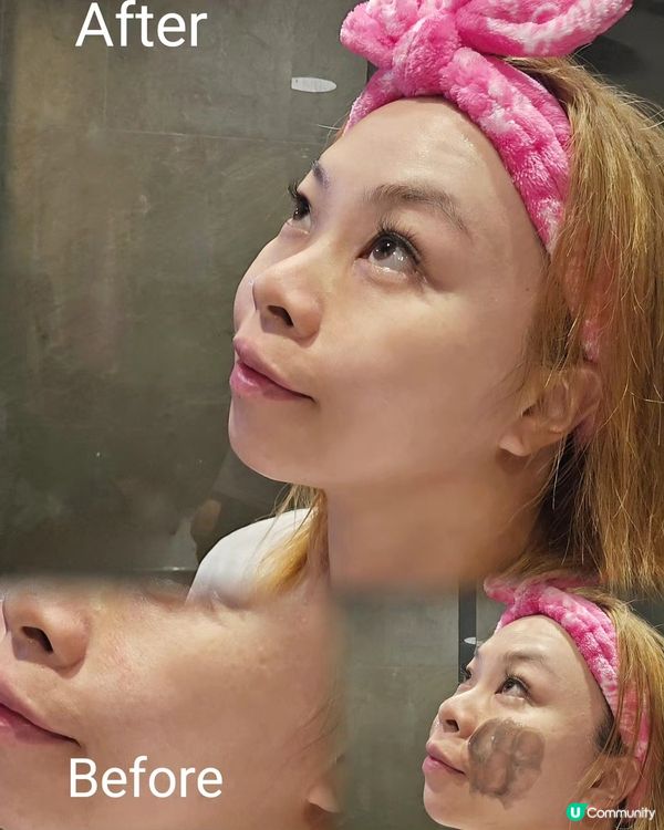 清黑頭、清粉刺 ～ 毛孔清潔透亮凍膜