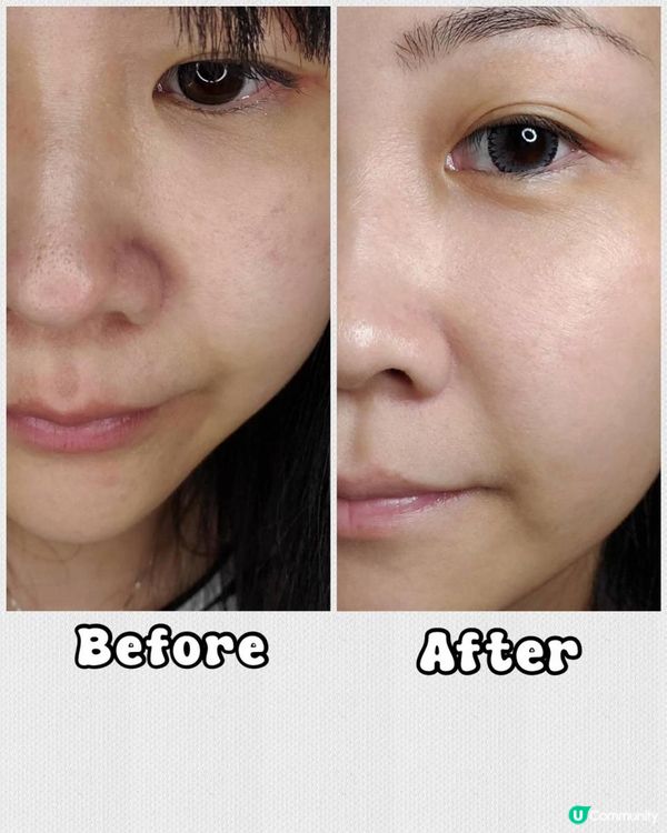 實驗去+medispa 打色斑，enLIGHTen 皮秒激光去斑有無效果？