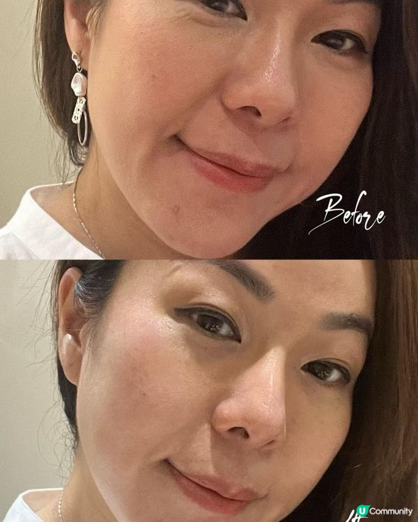 Cellec V 光子嫩膚療程