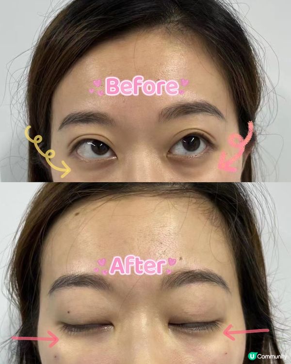 #7D唔開刀去眼袋 長得20年保障