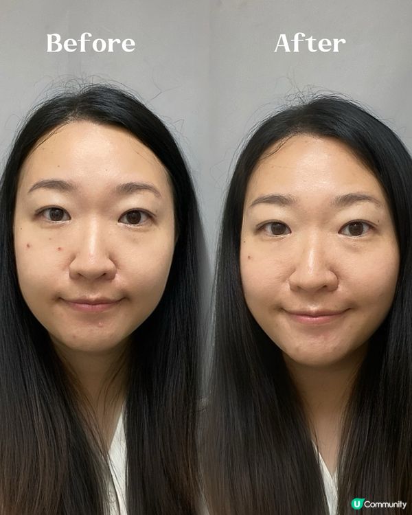 養康中醫館出祛暗瘡中藥藥膜