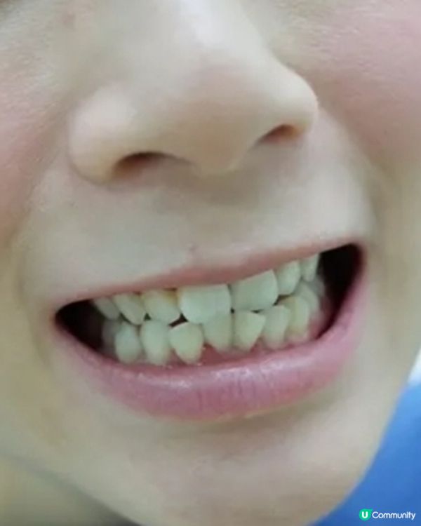 平時食嘢要留意，澳門補牙價錢贵，珠海補牙實惠又穩陣