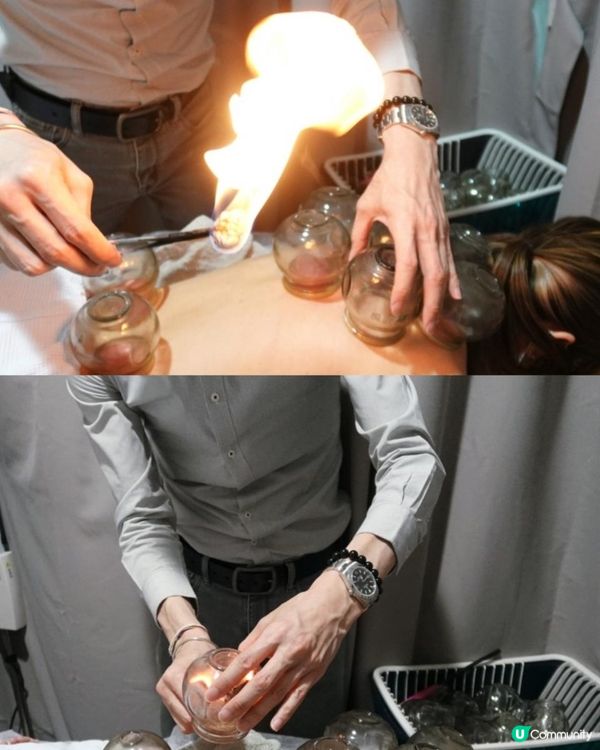 難怪養康中醫館人氣拔火罐袪濕氣療程成日大排長龍, 原來過程安全又舒服