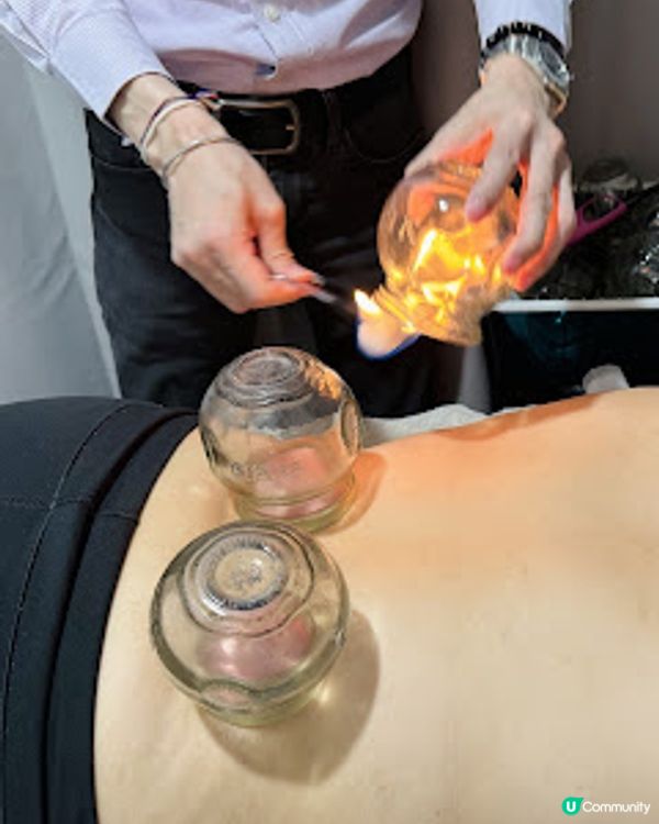 香港中醫館推介! 養康中醫館王牌拔火罐袪濕氣療程