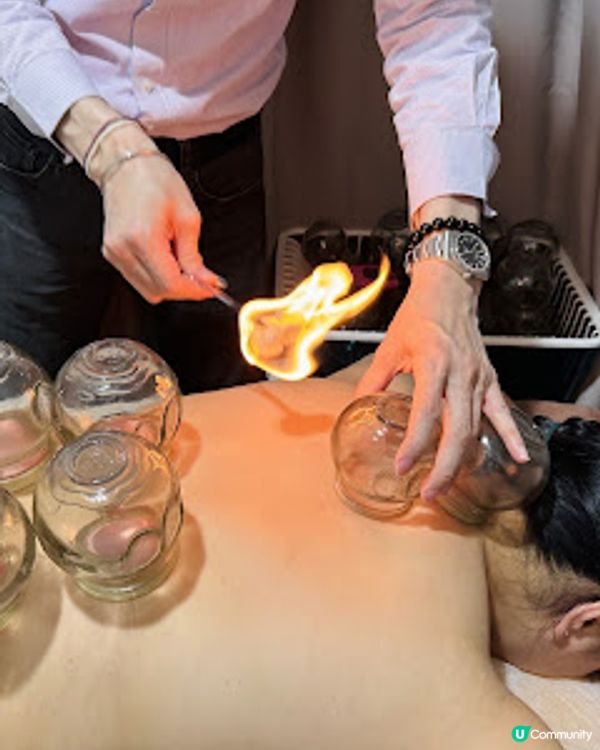 香港中醫館推介! 養康中醫館王牌拔火罐袪濕氣療程