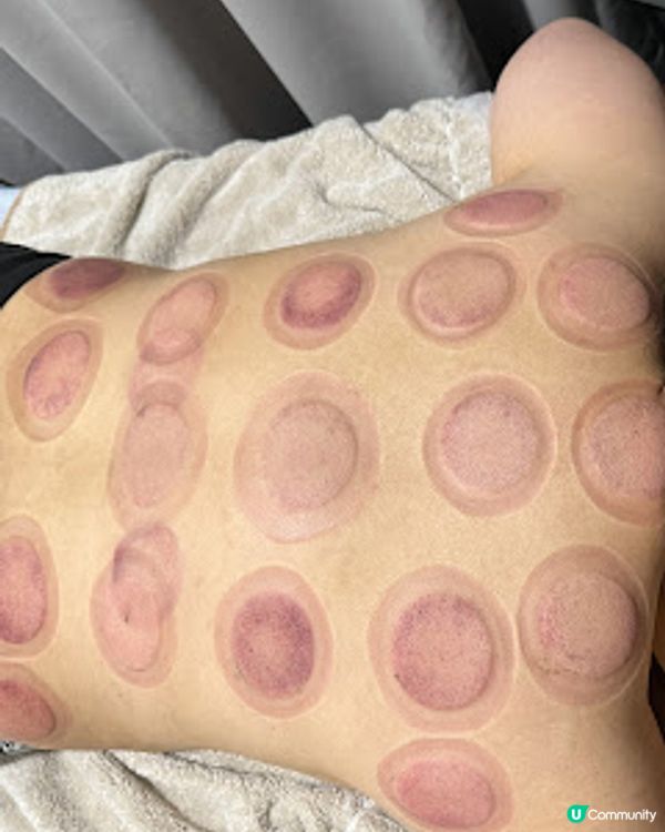 香港中醫館推介! 養康中醫館王牌拔火罐袪濕氣療程