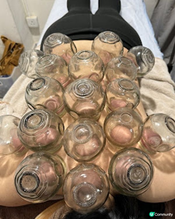 香港中醫館推介! 養康中醫館王牌拔火罐袪濕氣療程