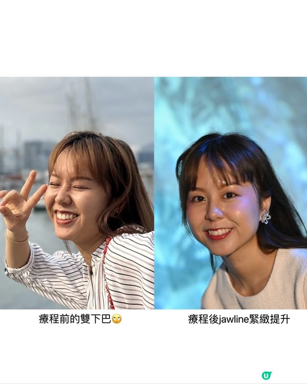 還原立體童顏肌✨✨ New Doublo SD微雕拉提