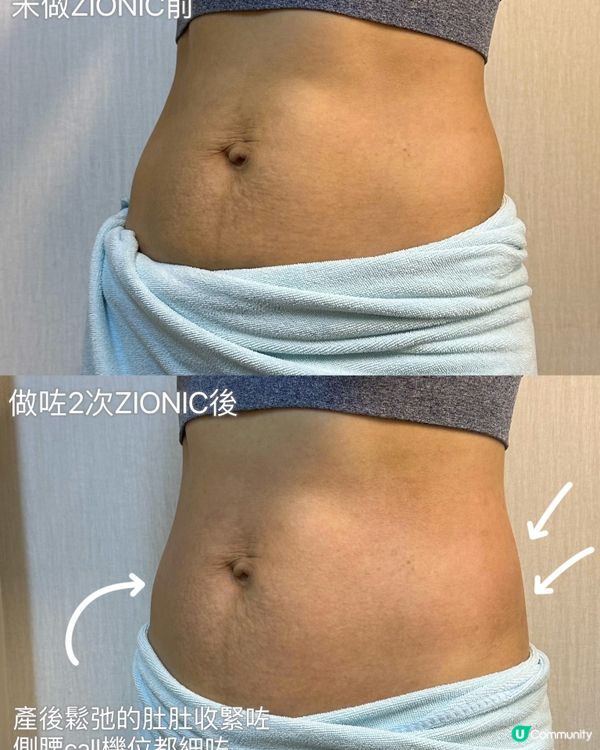 拯救產後鬆弛腰肚，快速瘦身 「ZIONIC 水母機」