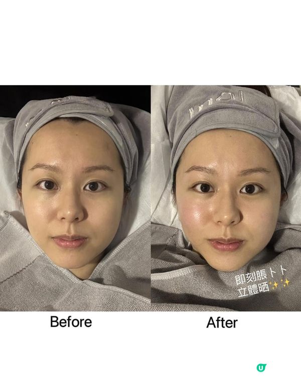 【醫美】moi aesthetics 體驗結合HIFU + RF "New Doublo SD微雕拉提"