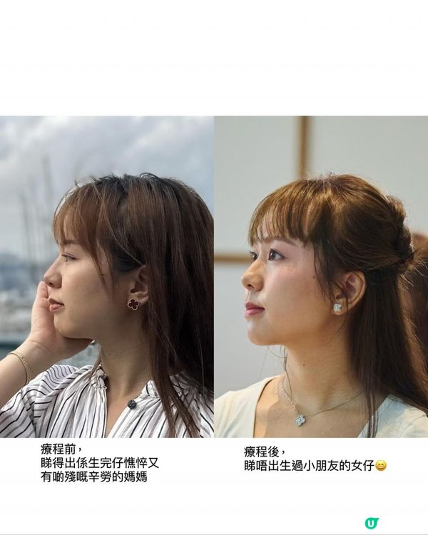 【醫美】moi aesthetics 體驗結合HIFU + RF "New Doublo SD微雕拉提"