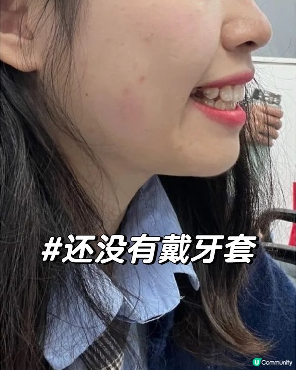 珠海正畸嘅個人感受同經歷