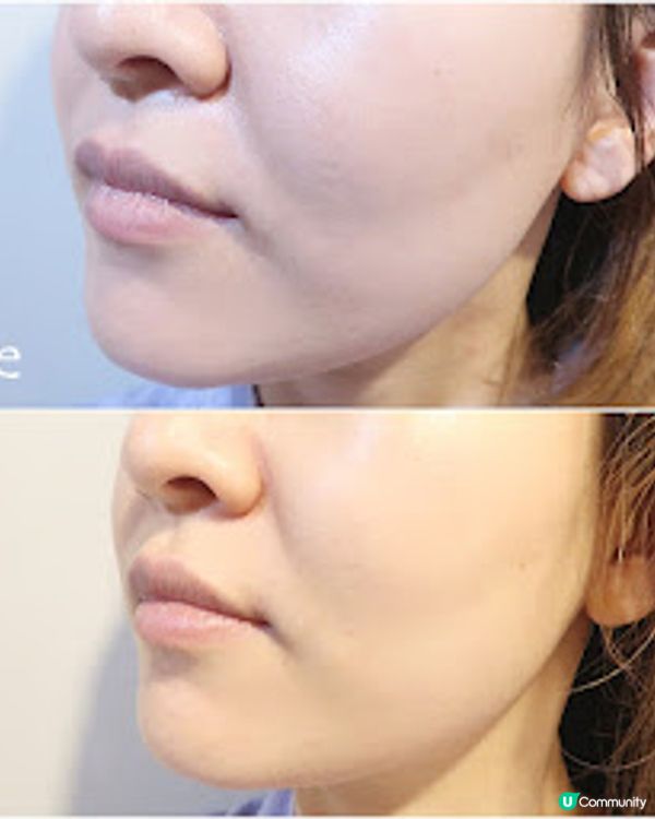 MediBeauty ❤ 4S逆轉肌齡細胞機療程