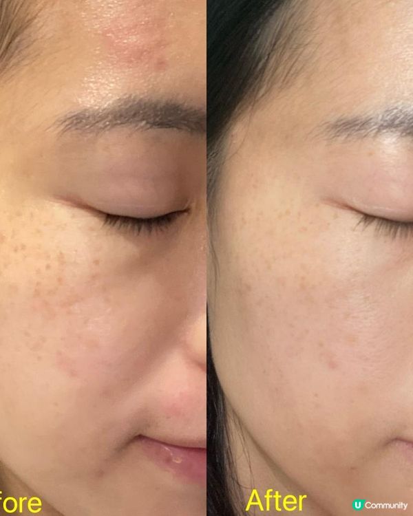 安全有效M22美白祛斑療程