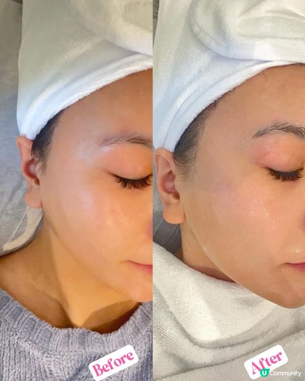 女人新年三寶之一：facial ！ 收毛孔大作戰 Fractional CO2 Laser (分段式二氧化碳激光) 