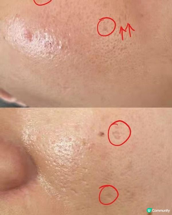 小資女搵自已塊面試平價CO2 LASER打凹凸洞DAY1