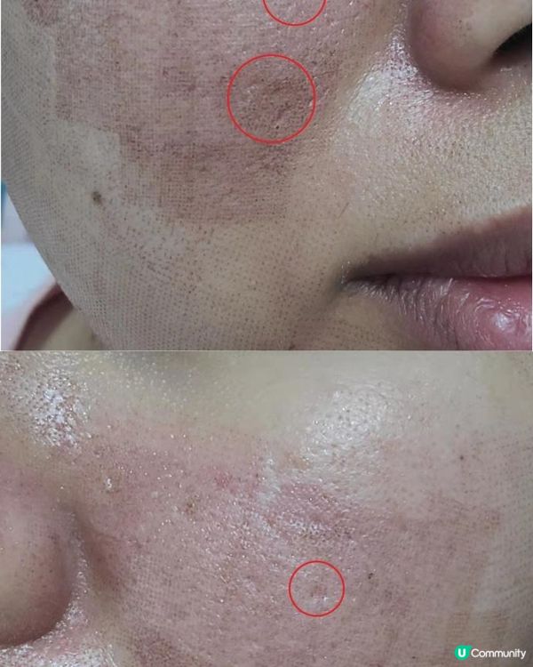 小資女搵自已塊面試平價CO2 LASER打凹凸洞DAY1