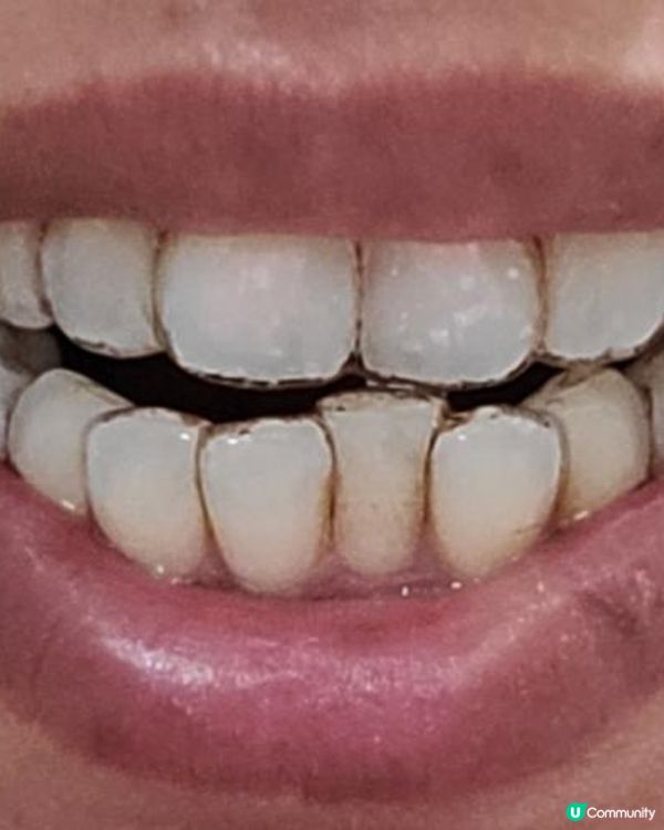 30歲先箍牙體驗(已箍完!人生最無後悔)