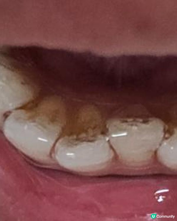 30歲先箍牙體驗(已箍完!人生最無後悔)