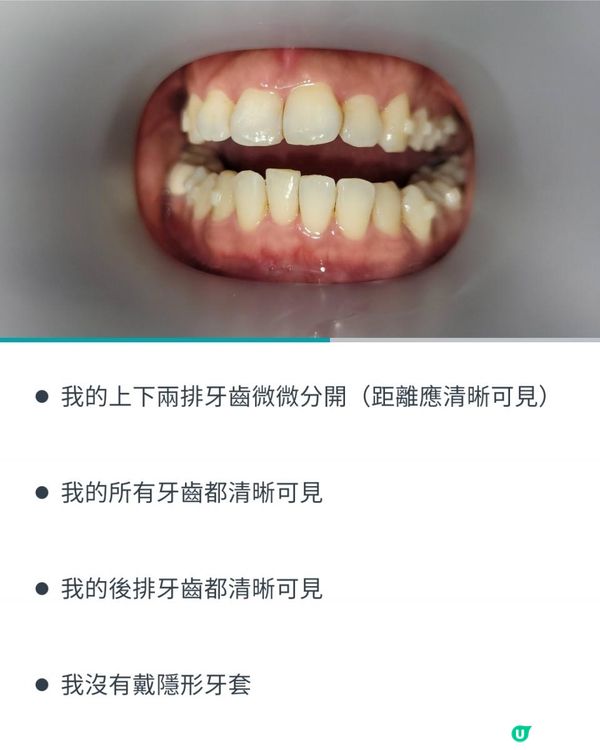 30歲先箍牙體驗(已箍完!人生最無後悔)