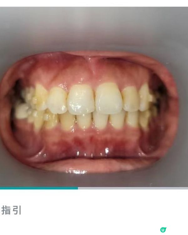 30歲先箍牙體驗(已箍完!人生最無後悔)