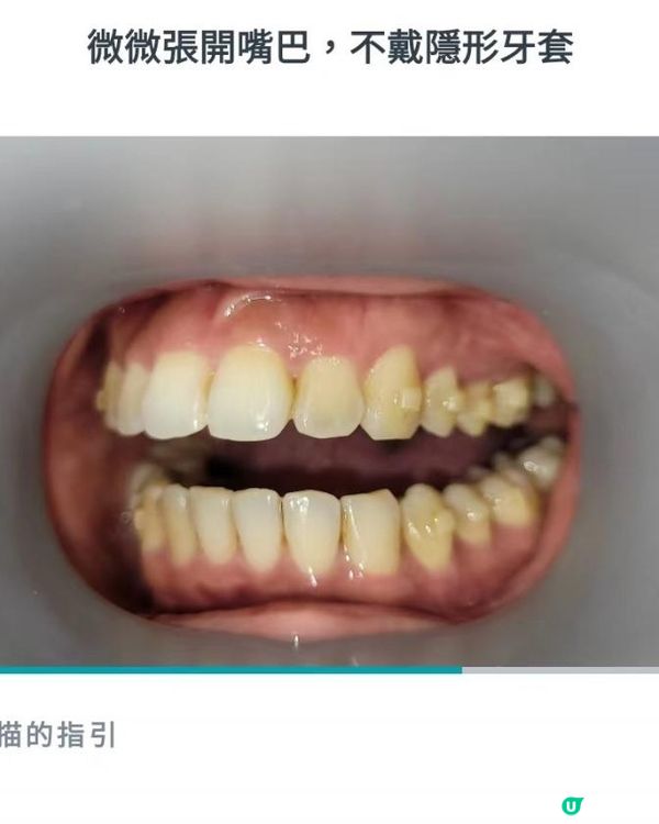 30歲先箍牙體驗(已箍完!人生最無後悔)