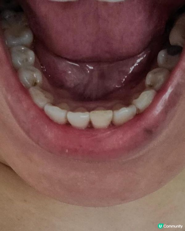 30歲先箍牙體驗(已箍完!人生最無後悔)