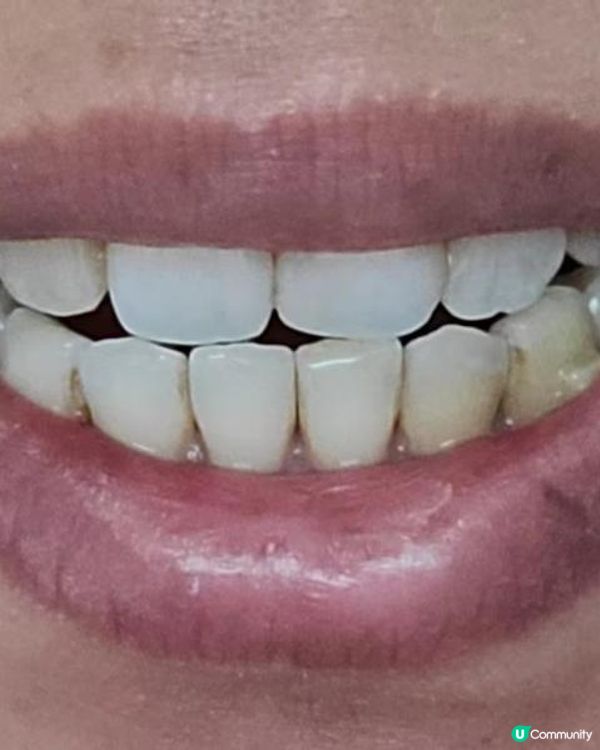 30歲先箍牙體驗(已箍完!人生最無後悔)