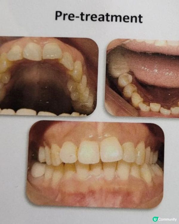 30歲先箍牙體驗(已箍完!人生最無後悔)