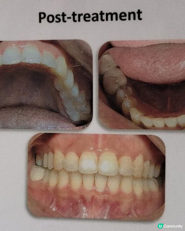 30歲先箍牙體驗(已箍完!人生最無後悔)