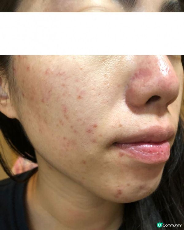 ｜美妝護膚｜ 內附大量爛面圖 + 復原過程｜遇見Miuns+ 魔鏡｜