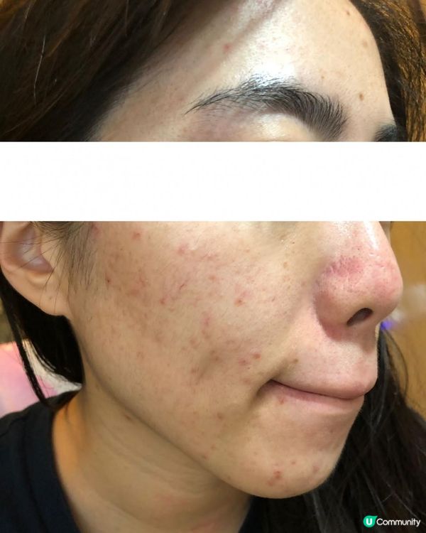 ｜美妝護膚｜ 內附大量爛面圖 + 復原過程｜遇見Miuns+ 魔鏡｜